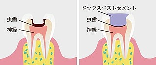 ドックべストセメント