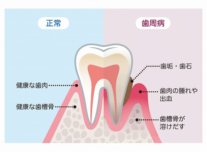 歯周病とは？