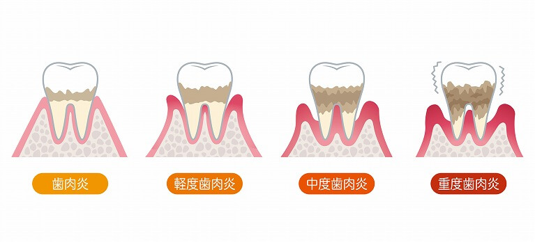 歯周病の症状と進行状態