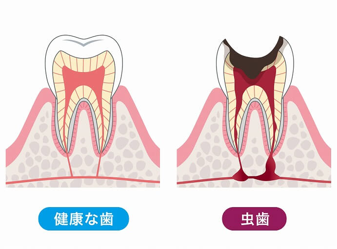 むし歯は早期発見と早期治療が大切です。